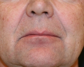 Feel Beautiful - Smile Lines Filling - Before Photo